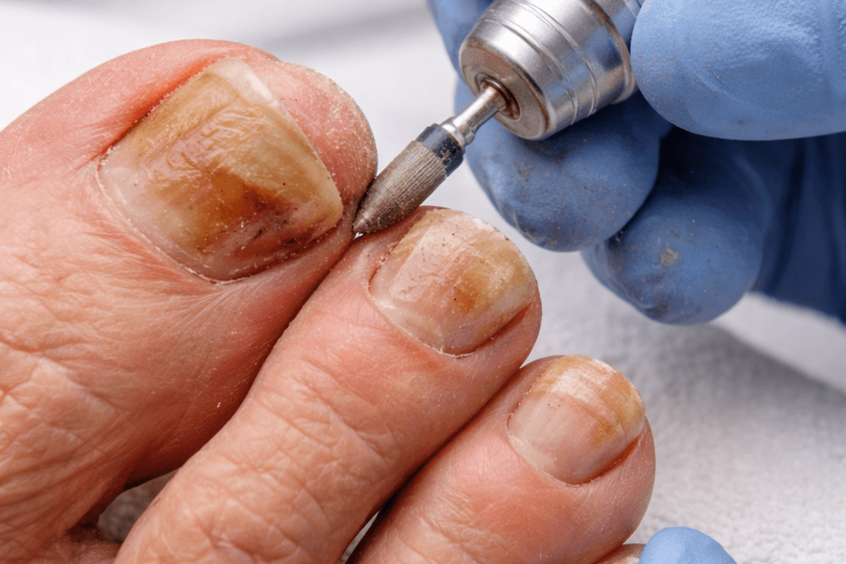 Podiatrist reducing a thick toenail with a drill during treatment