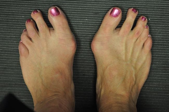 Forefoot Pain